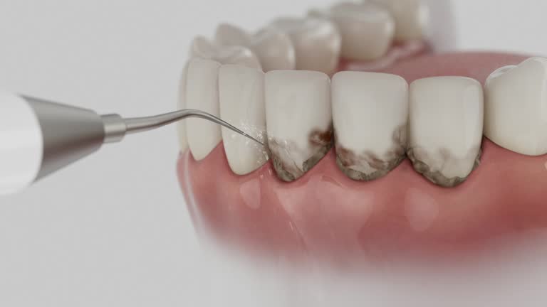 Trusted Wisdom Tooth Removal service in Winnsboro Mills, SC - Dentist Open Now
